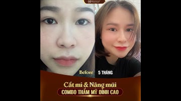 COMBO NÂNG MŨI & CẮT MÍ KHẮC PHỤC HOÀN TOÀN khuyết điểm