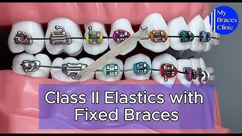 How to use class II elastics with Fixed Braces