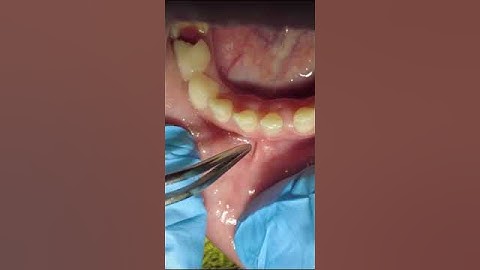 Răng Sữa Chưa Lung Lay Răng Vĩnh Viễn Đã Mọc  - Nguyên Nhân Do Đâu | Bác Sĩ Thoa Bình Dương