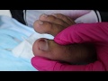 Ep_1444 Ingrown toenail removal 👣 ดูแลแผลเหมือนเดิมนะ 😷 (This clip is from Thailand)