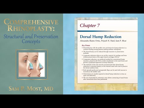 Video thumbnail: Comprehensive Rhinoplasty Chapter 7:  Dorsal Hump Reduction · sammost