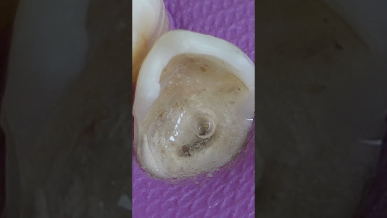 Tooth Cavity Unbelievable Restoration Shorts