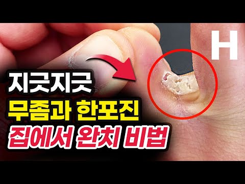 무좀 없애는 법, 한포진 치료 방법! 깨끗한 발을 만드는 가장 쉬운 방법은 바로 이것입니다