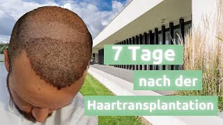 7 Tage nach der Haartransplantation  | Haartransplantation Türkei bei Dr. Serkan Aygin