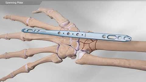 Spanning Plate