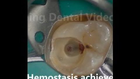 Partial pulpotomy 牙髓部分切斷