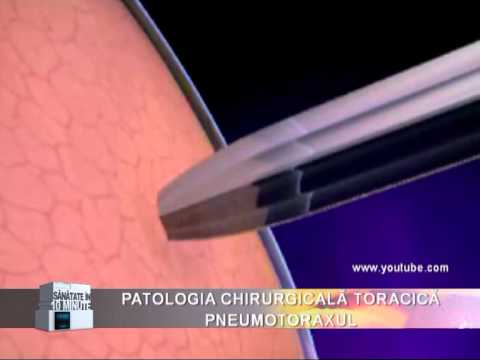 PATOLOGIA CHIRURGICALA TORACICA - PNEUMOTORAXUL