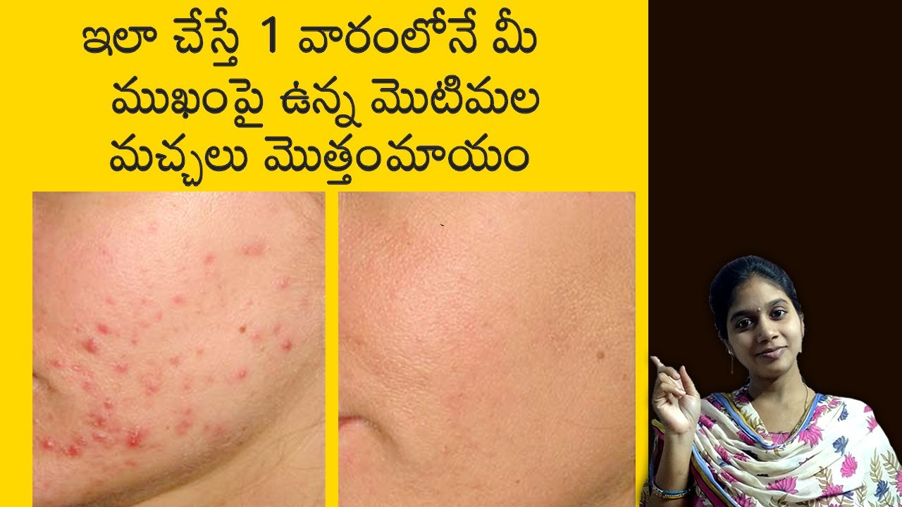 How To Remove Pimple Marks From Face Naturally in Telugu I Hema's