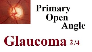 primary open angle glaucoma 2/4
