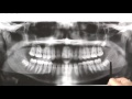 IMPACTED WISDOM TEETH AND THE PROBLEMS THEY CAUSE