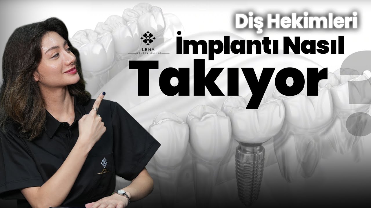 🤍 Как стоматологи устанавливают зубные импланты? Больно ли это? — Стоматологическая клиника Lema