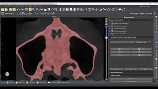 AI Driven Automatic Bone Segmentation in Blue Sky Plan!!!!