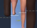 The Surgery That Turns Your Foot Into a Knee! 😱🦵 🇱🇷