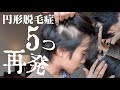【悲報】円形脱毛症が５つも再発しました。