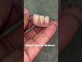 Upper partial denture 😬😬😬#apexdental #splittooth #dentistry #partialdenture #orthodontist