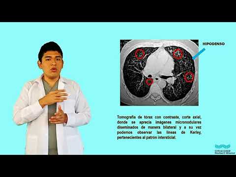 Vídeo: Tuberculosis Miliar: Causas, Síntomas, Diagnóstico