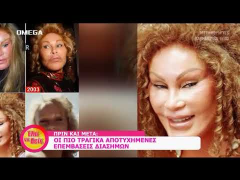 Βίντεο: Φωτογραφίες του Live Ken-Barbie εμφανίστηκαν στο δίκτυο μετά από ανεπιτυχή πλαστική χειρουργική επέμβαση