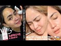 HOW I GOT RID OF MY PIMPLES || RYX SKINCERITY BEYOUTHIFUL STARTER KIT PERSONAL JOURNEY