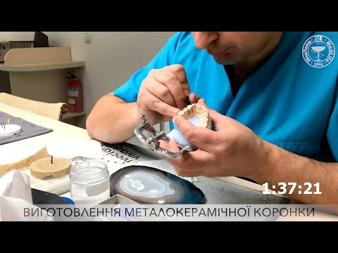 Изготовление металлокерамической коронки.