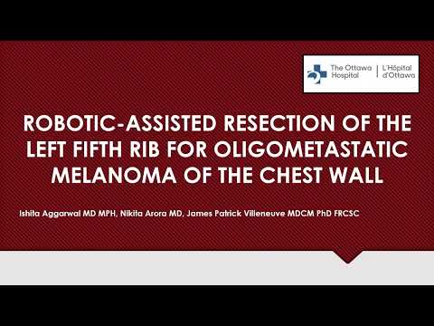 Robotic-Assisted Resection of the Left Fifth Rib for Oligometastatic Melanoma of the Chest Wall
