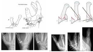 OrthoFracs Base of Thumb Trauma by Dr. James Drummond screenshot 4