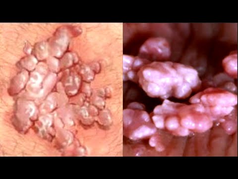 Video: Negii HPV mâncărime?