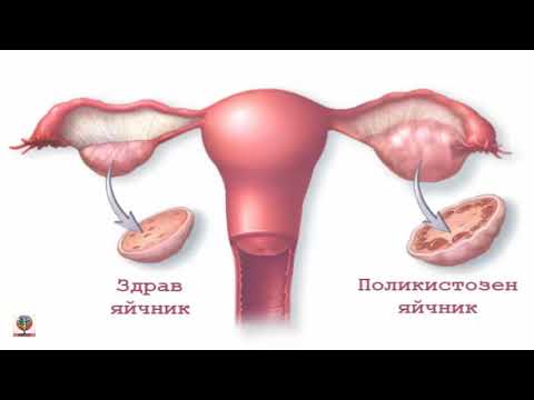Видео: Симптоми и лечение на възпаление на яйчниците при жените
