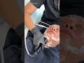 Defined Jawline Results with UltraSculpt | No Downtime Skin Refinement