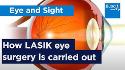 How LASIK eye surgery is carried out