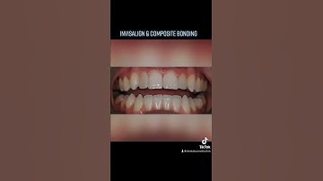 Invisalign, Whitening, Composite Bonding