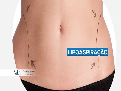 Dr. Moises De Melo | Lipoaspiração