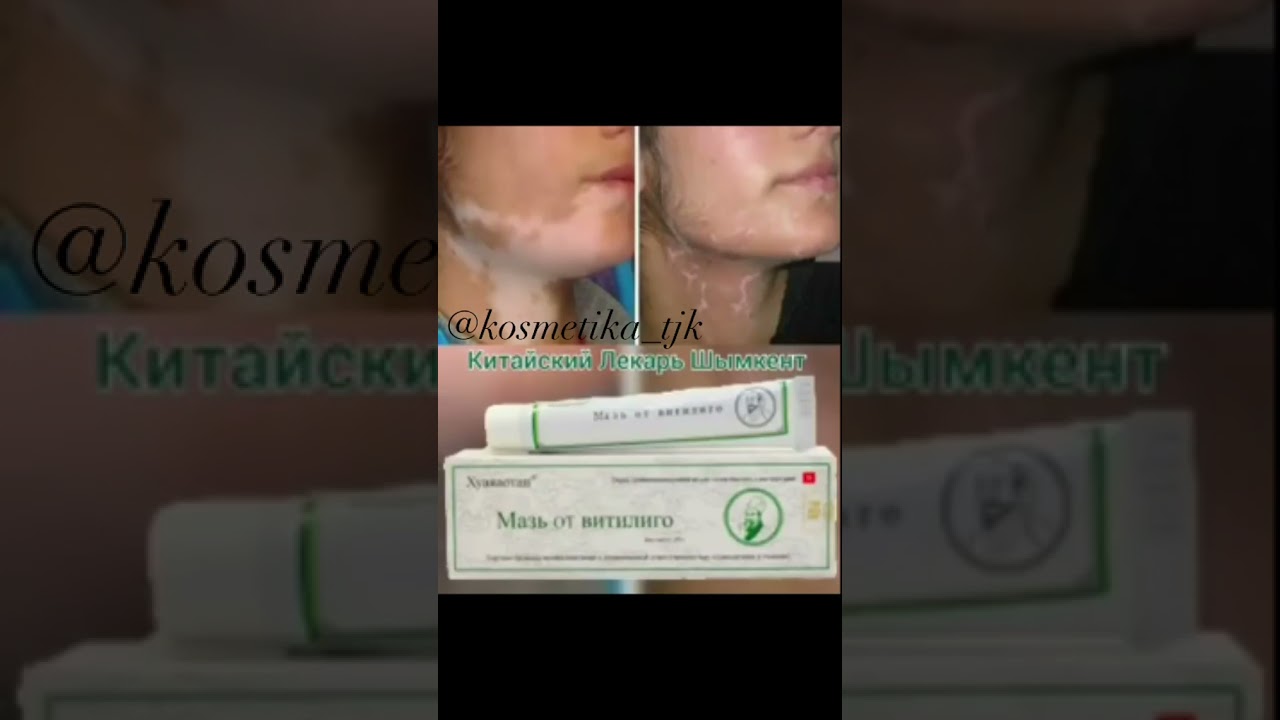 лудший мазь от витилиго