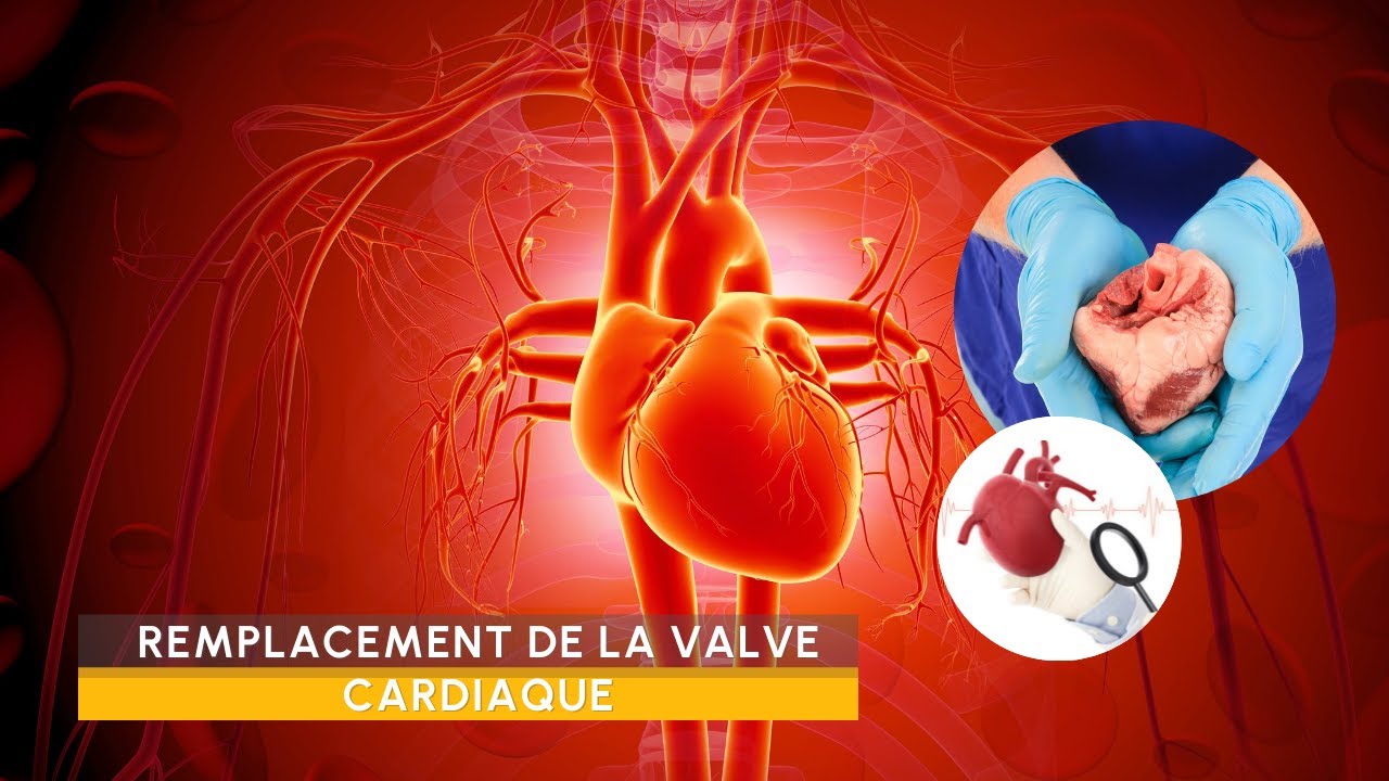 Prix du remplacement Valve Cardiaque (aortique) en Turquie