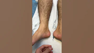 Shin Splint الم الساق الامامي عند الجري 