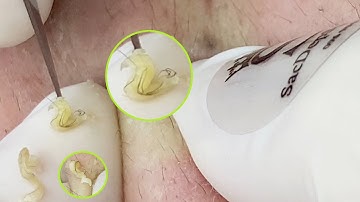 Pimples And Ingrown Hair P2 | Lông Mọc Ngược Gây Mụn P2 - SacDepSpa#228