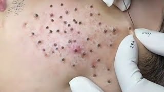 Make your day Relax with Relaxing LNS / blackheads removal/ blackheads animation blackheadsremoval
