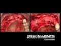 Ridge augmentation with dptfe technique by jerry c lin dds dmsc