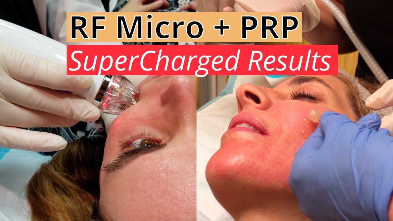 Supercharged Results Rf Micro Prp [vampire Facial Mega Upgrade For