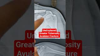 Undisplaced Greater Tuberosity Avulsion Fracture ...Dr Sai Chandra..Knee N Shoulder Surgeon