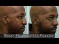 Dallas Revision Rhinoplasty and Lip Reduction Testimonial with Before and After