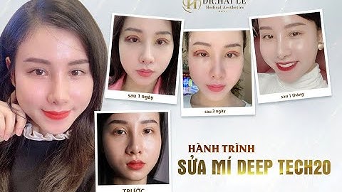 CẢM NHẬN SAU 1 THÁNG SỬA MÍ DEEP TECH20