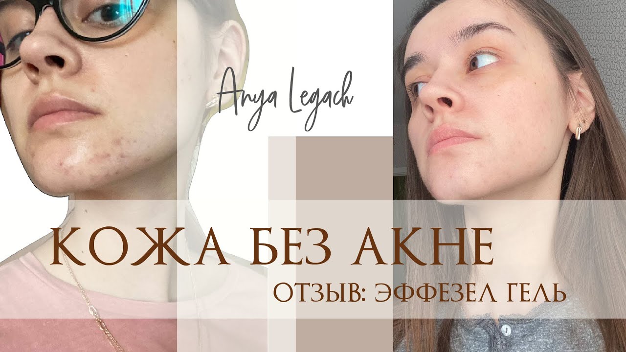 ЭФФЕЗЕЛ: крем ОТ АКНЕ | ОПЫТ ИСПОЛЬЗОВАНИЯ | ДО и ПОСЛЕ ФОТО - YouTube