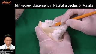 5. Maxillary Palatal Alveolar (When and How to use 