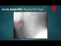 Acute Epiglottitis: Thumb Sign