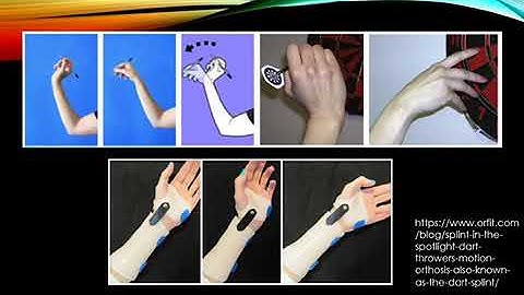 Dart Thrower’s Orthosis