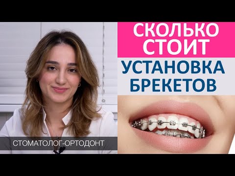 Сколько стоит установить брекеты. Стоимость установки металлических и керамических брекетов.