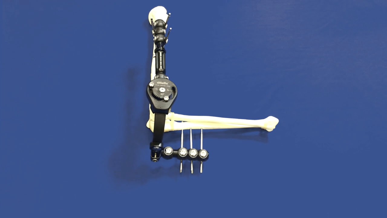 ST.A.R.90 F4 Elbow Fixator R.O.M. limiter