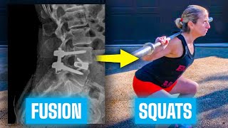 Before & After | Life after Spinal Fusion