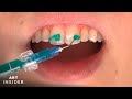 How White Teeth Spots Are Removed