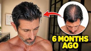 Cara Saya MENGATASI Kerontokan Rambut dan Menghentikan Kebotakan